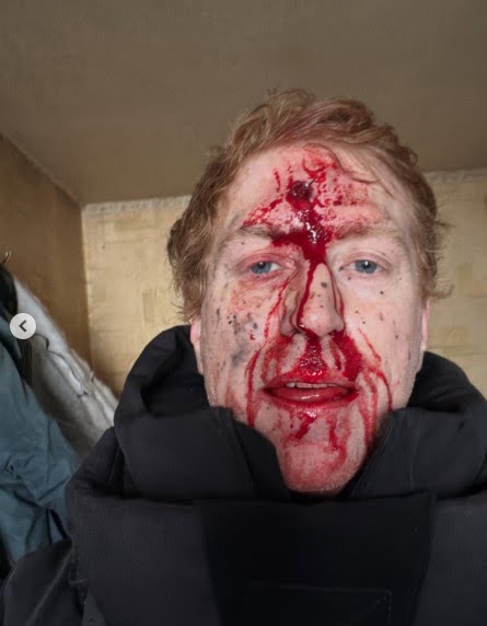 A close-up of Denys Khristov's face showing an open forehead wound and bloodstains following an enemy attack.