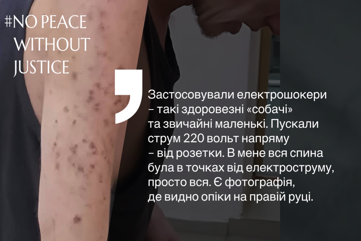 Сліди опіків на руці Дмитра Кануп’єра від електричного струму під час полону